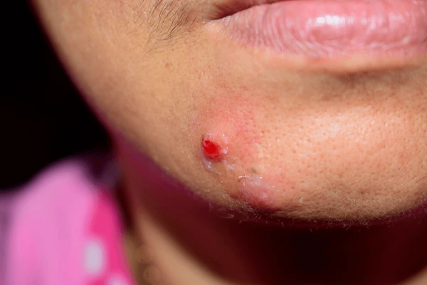 skin growth Treatment in Lucknow